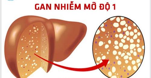 Người bị gan nhiễm mỡ nên ăn gì để cải thiện tình trạng sức khỏe?